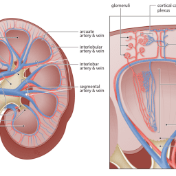 RENAL VEIN STENOSIS 11 RVS 1